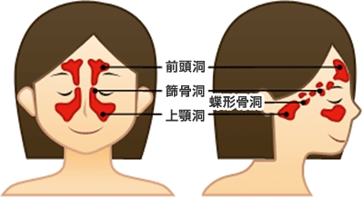 鼻中隔弯曲症