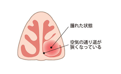 なぜ効く？点鼻薬 鼻づまりの原因と点鼻薬
